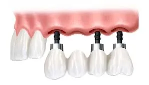 Diş İmplantı mı, Diş Köprüsü mü?